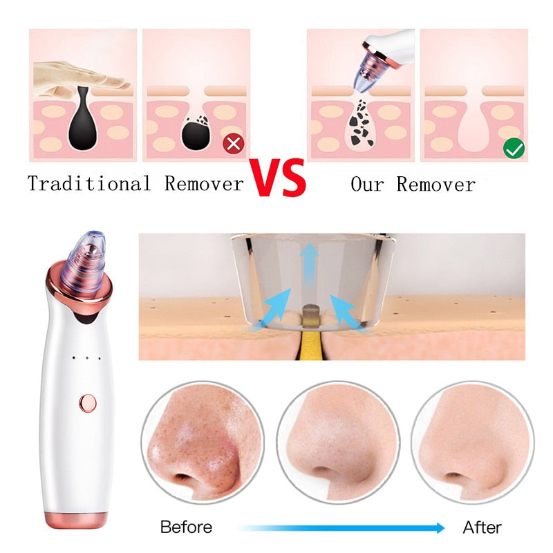 Electric pore cleaner and blackhead remover